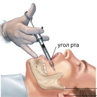 МАНДИБУЛЯРКА