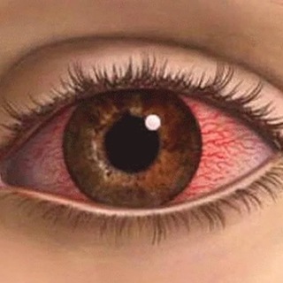 СОЛЯНАЯ КИСЛОТА